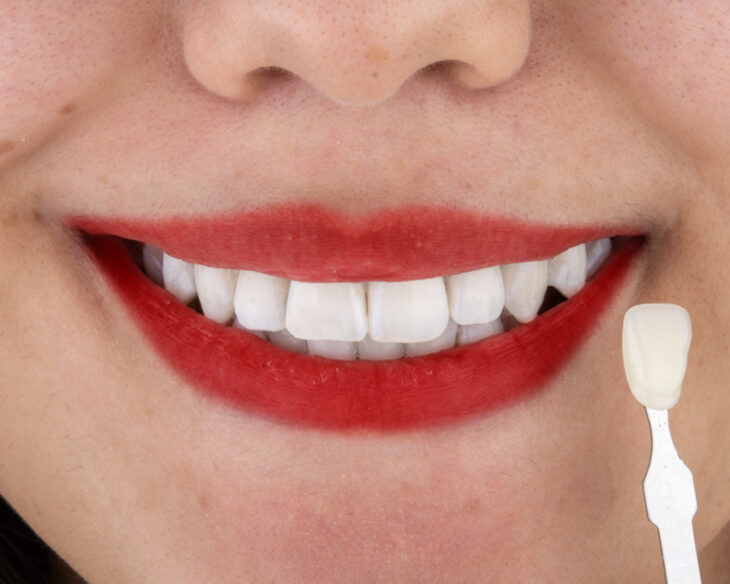 هزینه بلیچینگ در اصفهان | دکتر مینو صلواتی