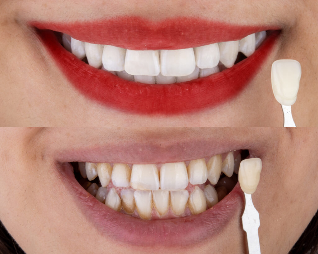 هزینه بلیچینگ دندان در اصفهان | دکتر مینو صواتی